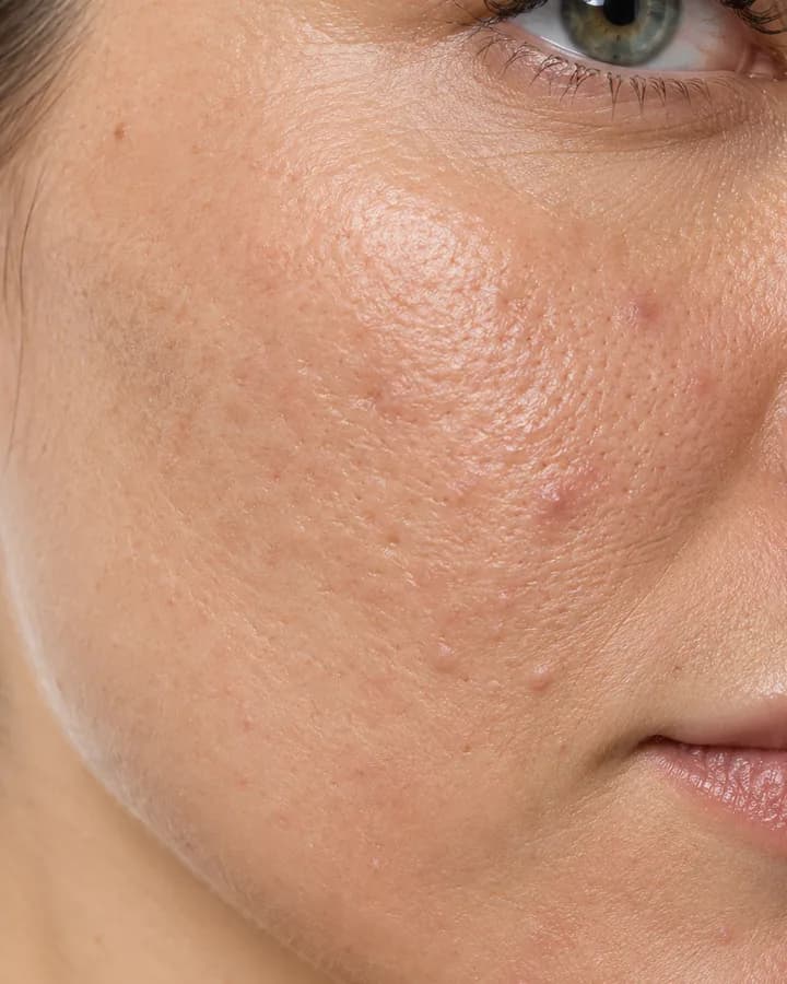 Une peau à la texture irrégulière, avant. Illustration.